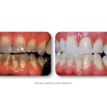 Simply Whiter Teeth Before And After Case 29