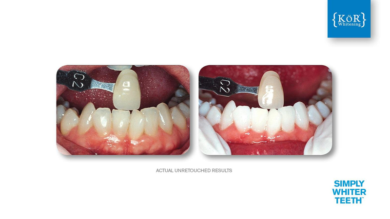 Simply Whiter Teeth Before And After Case 30