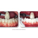 Simply Whiter Teeth Before And After Case 30