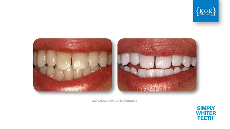 Simply Whiter Teeth Before And After Case 4