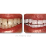 Simply Whiter Teeth Before And After Case 4