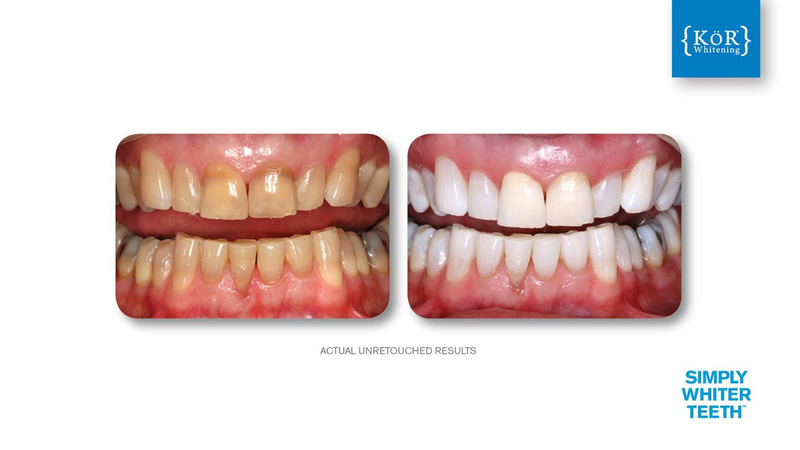 Simply Whiter Teeth Before And After Case 5