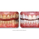 Simply Whiter Teeth Before And After Case 5
