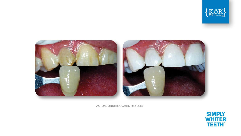 Simply Whiter Teeth Before And After Case 6