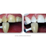 Simply Whiter Teeth Before And After Case 6