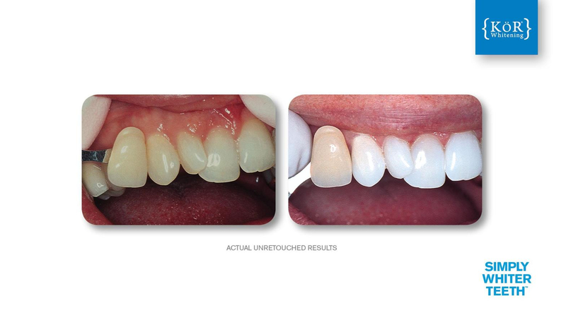 Simply Whiter Teeth Before And After Case 7