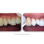 Simply Whiter Teeth Before And After Case 7