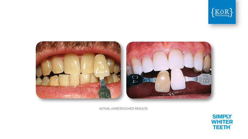 Simply Whiter Teeth Before And After Case 8