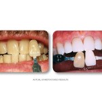 Simply Whiter Teeth Before And After Case 8